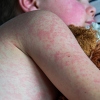 A child covered in a red rash.